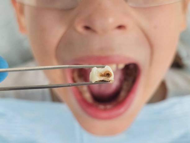 Best Broken or Cracked Tooth Emergency Dentist in Uniontown, AL
